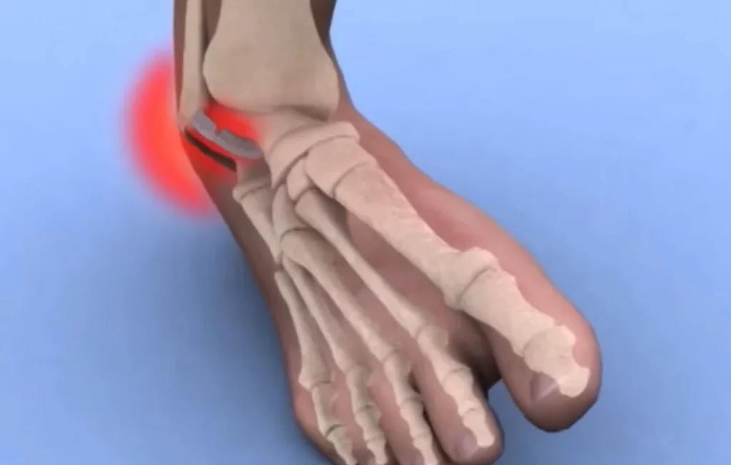 Common Leg Injuries